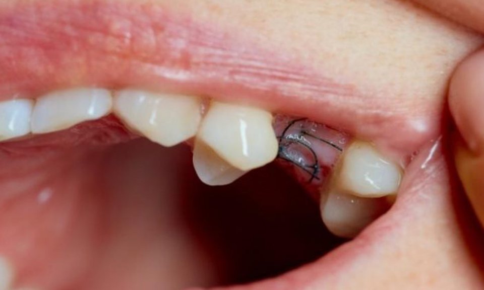 Close-up of healing gums with stitches after a tooth extraction