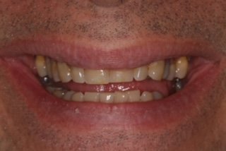 Patient smile before treatment