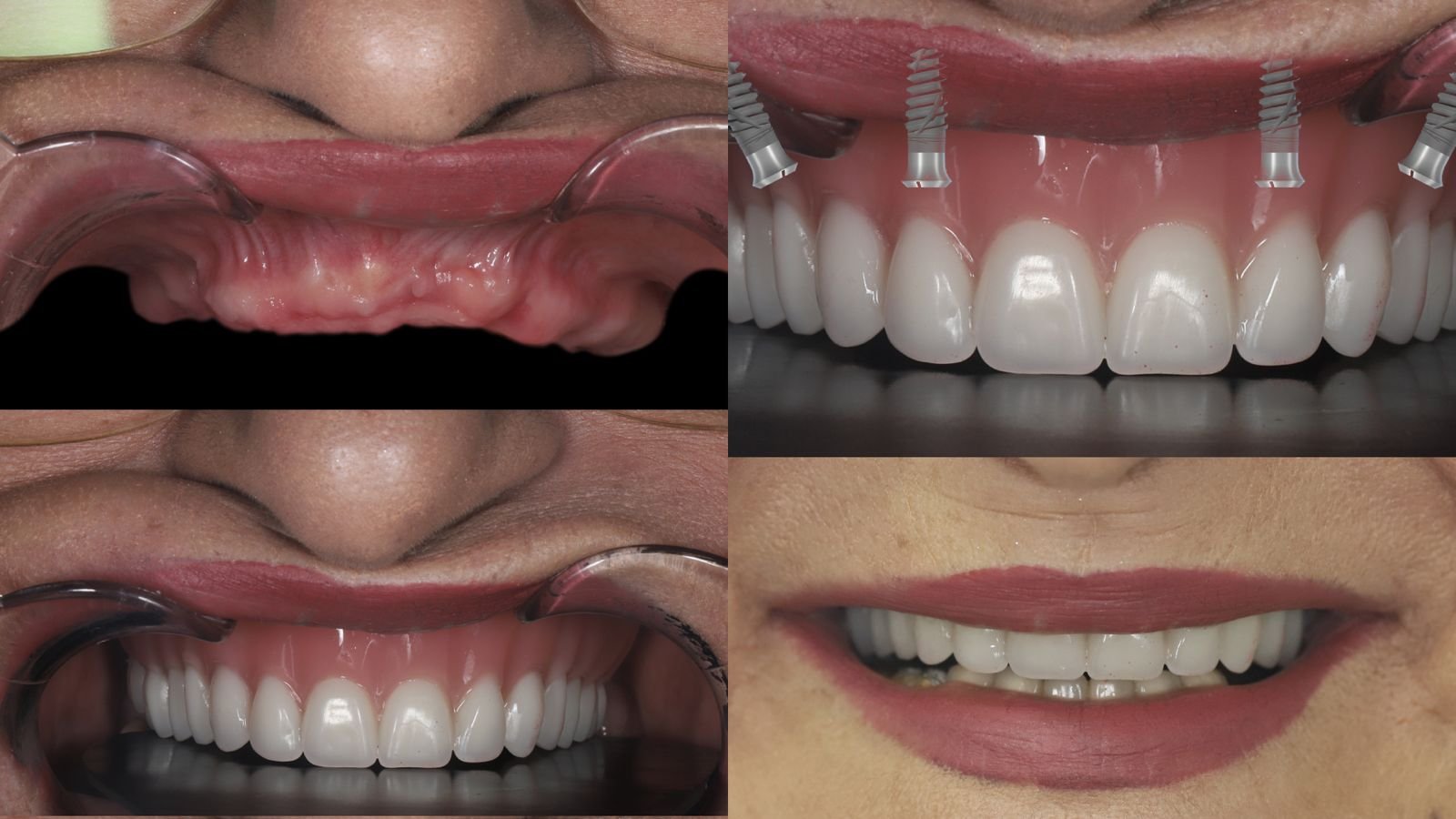 dentAL Implants 1