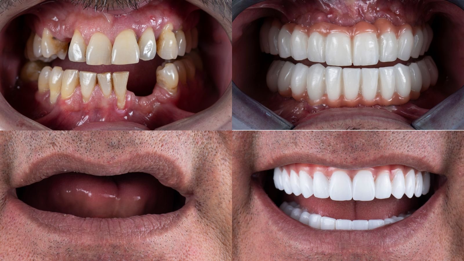 dental inplants 2